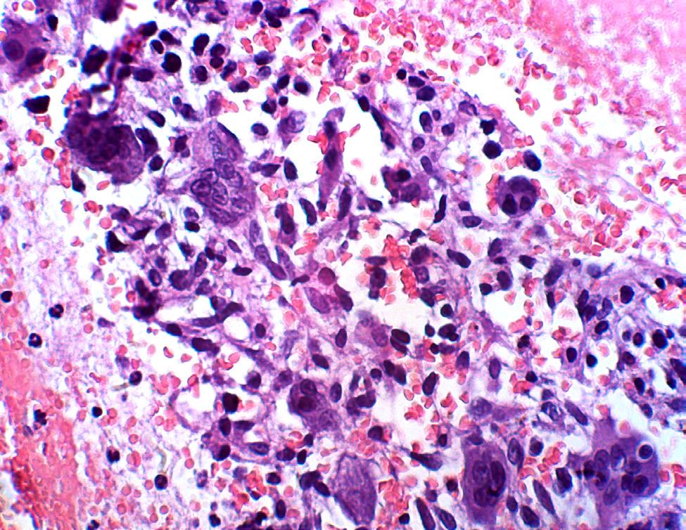 A-554 Giant Cell Lesions of Bone Results The osteoclastoma is maximum of all benign lesions.