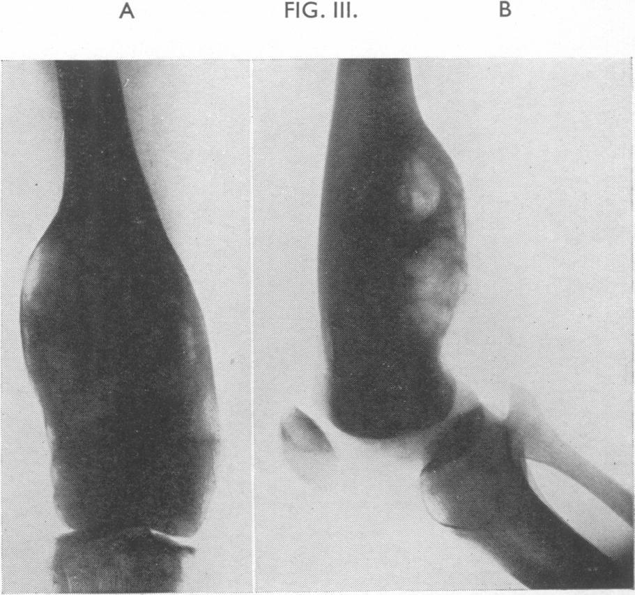Multiple metastasis and death within twelve months. A. Antero-posterior view. B. Lateral view. FIG. III.-A and B. Osteoclastoma of femur.