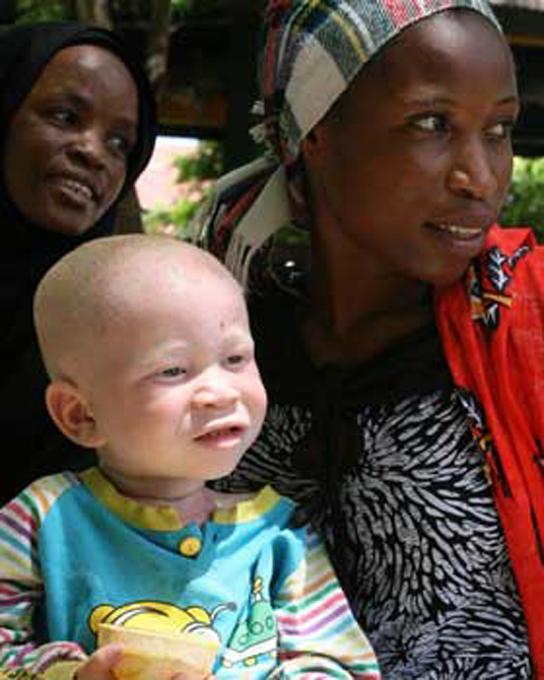 The allele for albinism, expressed here in humans, is recessive. Both of this child s parents carried the recessive allele.