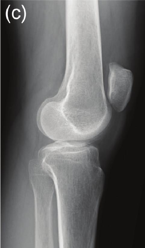 on the femoral intercondylar notch during knee extension. (c) Lateral view of the left knee joint at the time of initial examination at our hospital.
