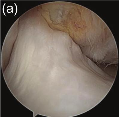 4 Case Reports in Orthopedics (c) (d) Figure 5: (a, b) Preoperative arthroscopic results, showing that the parenchymal fibers of the anterior cruciate ligament (ACL) were normal, whereas the avulsed