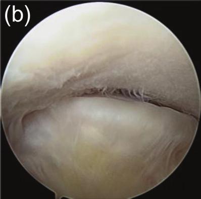 (c, d) Arthroscopy after debridement, showing that (c) the anterior region of the avulsed fragment was shaved, the posterior region of the ACL attachment site of the tibia was conserved, and the