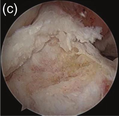 eminence is accompanied by arthroscopically determined degeneration of the ACL fibers; rather, one-stage ACL reconstruction may be required [6].