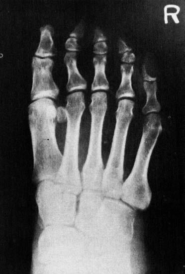 RADIOGRAPHIC EXAMINATION OF THE FEET 133 Fig.