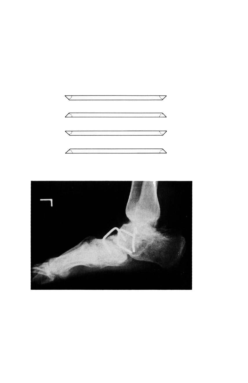 471" I.gin RADIOGRAPHIC EXAMINATION OF THE FEET 135 C-D 11.6 in B Fig. 7. Diagram for construction of sides B-C and B-D. A 11.6in D 47 \:;-' \J 43 47 L"-. /\. 43 A 11.6in C D B 43 'v' \-/ 47 43 /",-\.