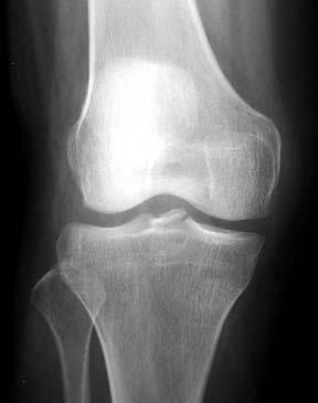 Classical Plain Film Findings Segond Fracture: