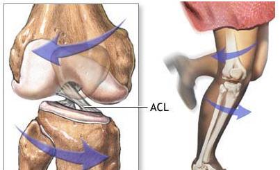 Typical ACL Injury Non-contact injury occurs in 70% of cases.