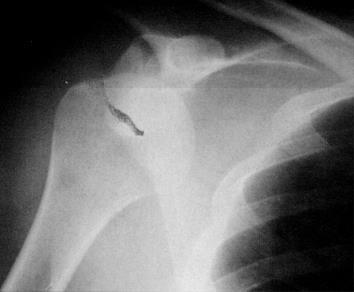 Anterior Dislocation Anterior displacement of humerus Defect of humeral head (HS