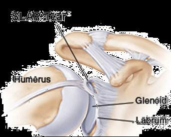 About the shoulder The shoulder is made up of 3 bones: the Scapula (shoulder blade), the Humerus, (upper arm bone) and the Clavicle (collar bone).