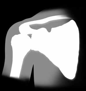 If you have a massive, irreparable rotator cuff tear and arthritis, your surgeon may opt to perform a reverse shoulder replacement.