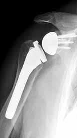 Once your surgeon exposes your shoulder joint, the surgeon will remove the damaged bone and cartilage.
