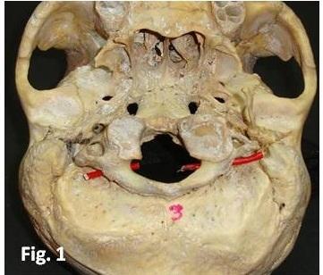 The cranial half of first cervical sclerotome combine with the caudal half of last occipital sclerotome to form the base of skull.