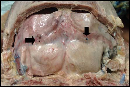 The soft tissues were removed in order to expose the posterior cranium, from inion to the foramen magnum and laterally to the mastoid process on both sides.