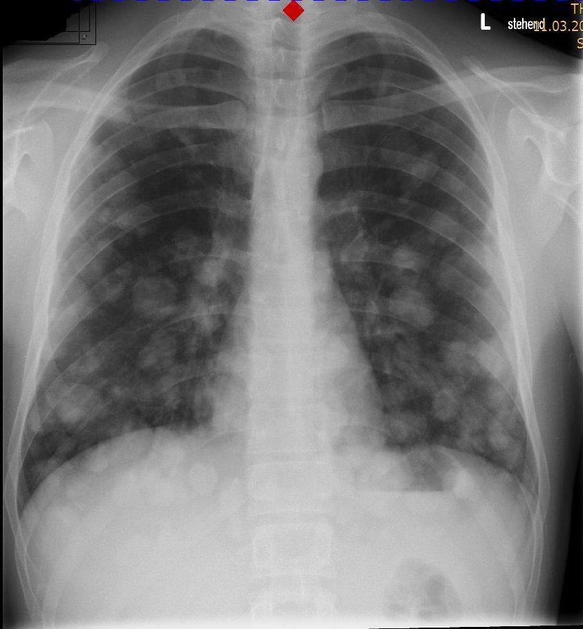Chest x ray... Multiple nodular infiltrates in both lungs.