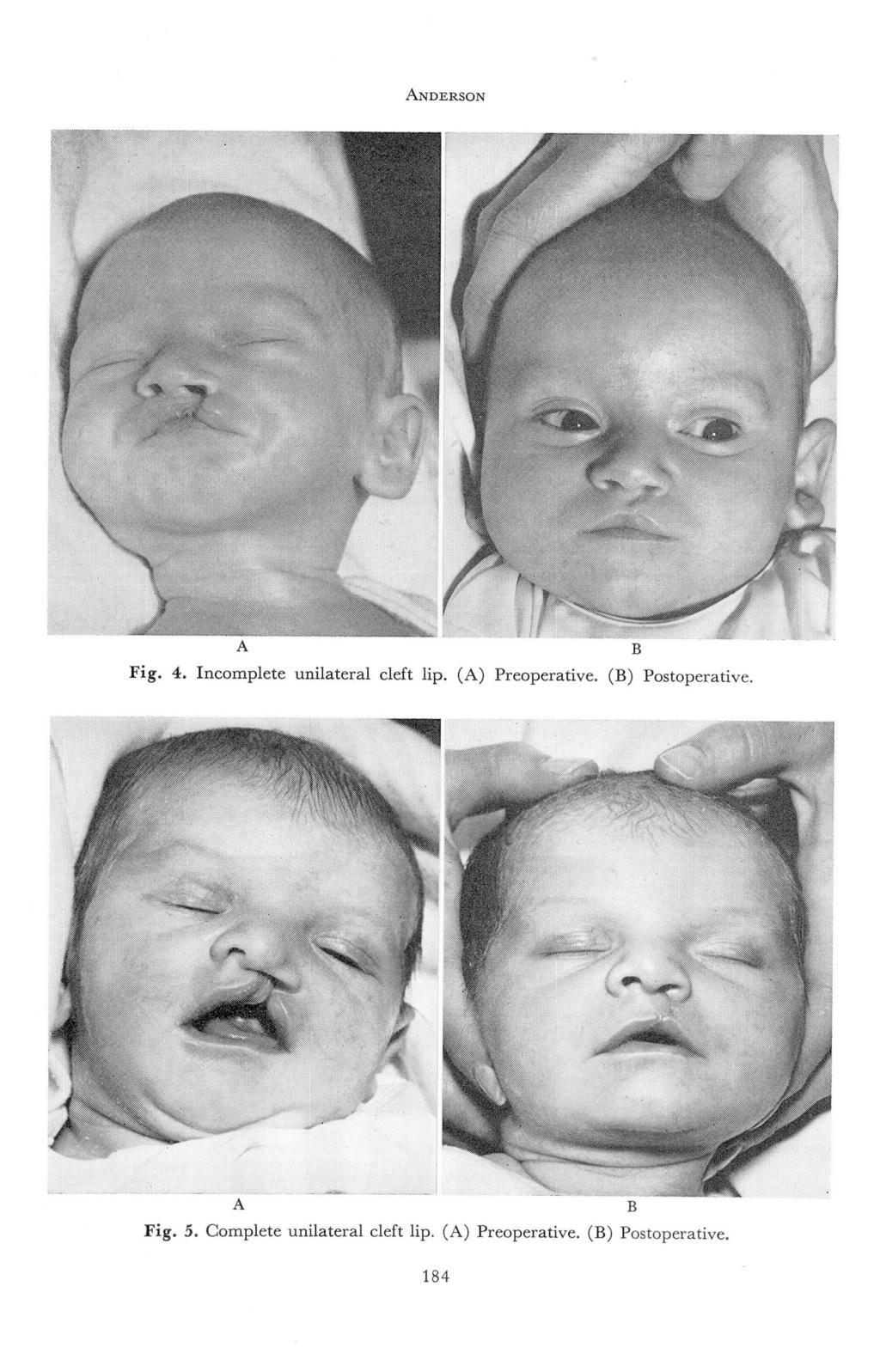ANDERSON Fig. 4. Incomplete unilateral cleft lip. (A) Preoperative.