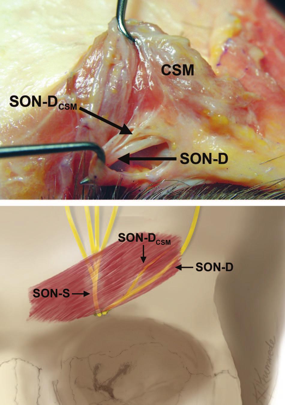 Plastic and Reconstructive Surgery January 2008 Fig. 3. Type I supraorbital nerve branching pattern.