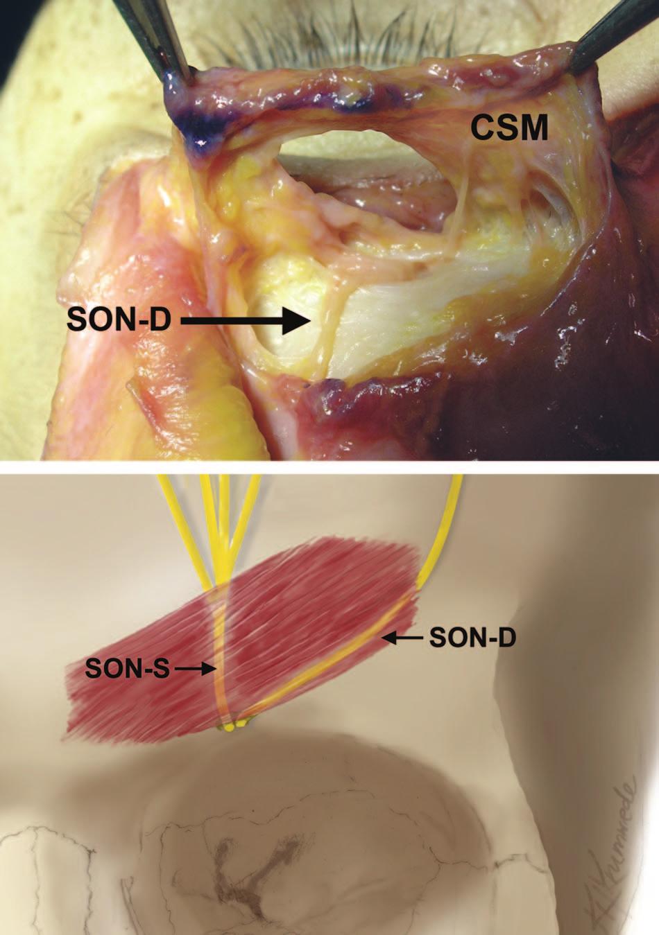 supraorbital nerve. Fig. 6. Type IV supraorbital nerve branching pattern. (Above) Note the change in orientation.