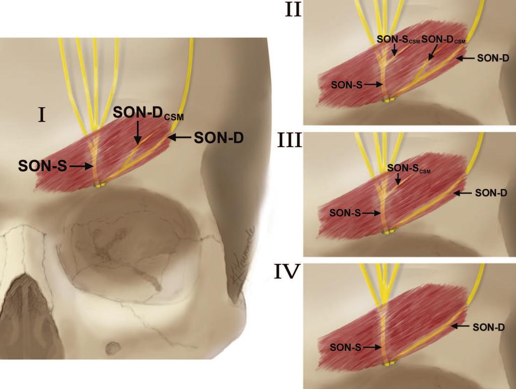 Plastic and Reconstructive Surgery January 2008 Fig. 7. Summaryofsupraorbitalnervebranchingpatternclassification.(Left) TypeIsupraorbital nerve branching pattern, the most common type (enlarged).