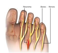 Mortons Neuroma - Pain in the ball of the foot, caused by irritation or compression of the nerves of the foot - Usually affects the nerve between the 3 rd and 4 th toe, sometimes between 2 nd and 3