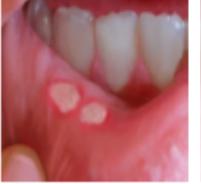 Common symptoms of oral mucositis/stomatitis due to any cause include the