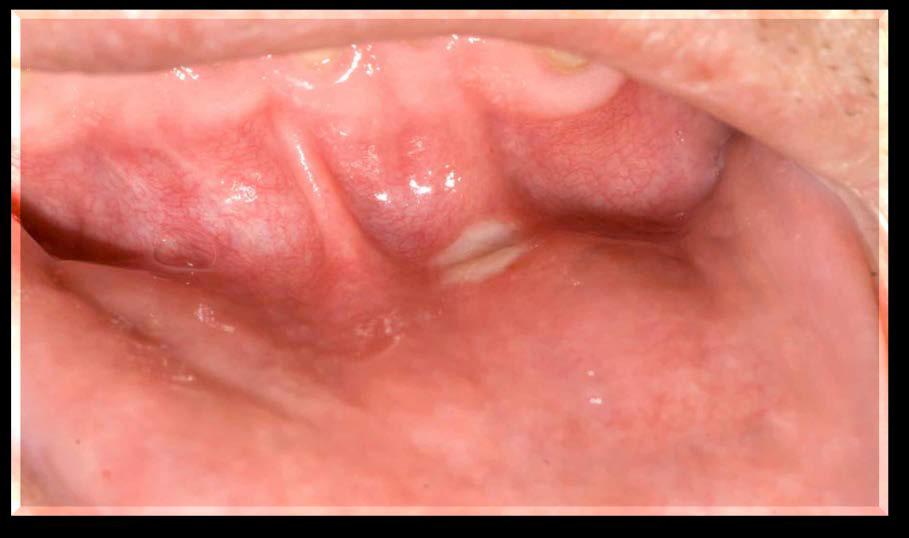 Stomatitis: Clinical Presentation mtor inhibitor-associated stomatitis 1,2 Distinct from chemotherapyinduced stomatitis Aphthous-like ulcers characterized by discrete, ovoid, superficial,