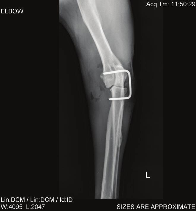 Figure 3. Reduced elbow luxation in a 4yo Beagle using the screws and cerclage wire surgical technique, CrCd view the humeral condyles (Figures 4, 5 and 6).