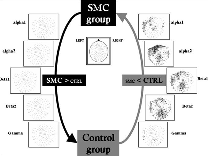 Resting/memory DTI/MEG Acetylcholine Conversion SMC AD/MEG
