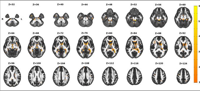 Path length Clustering White Matter Integrity