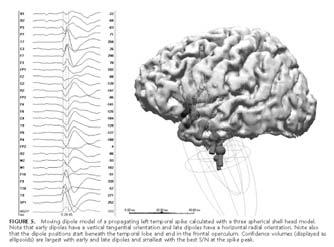 Temporal lobe epilepsy Ebersole et al 2007 Frontoemporal spike MNE approach A typical spike in Patient 1. The MNE-derived source distribution map of a spike obtained through (A) MEG; (B) EEG.