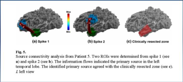spatiotemporal analysis of MEG spikes may provide more accurate information of spike propagation in our patients than EEG.
