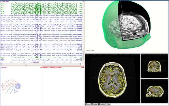 Neocortical epilepsy In patient one, one spike identified 3 primary regions Maybe multiple regions active simultaneously Epileptogenic zones spread