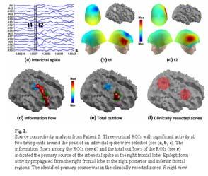 Neocortical epilepsy Diffusion Tensor Imaging (DTI) tractography demonstrated fibers more connected on epileptogenic