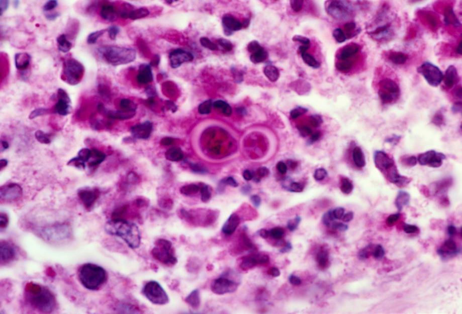 Blastomycosis (also known as North American blastomycosis,blastomycetic dermatitidis Infection occurs by inhalation of the fungus from its natural soil habitat.