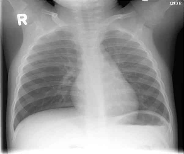 FIGURE 1: INSPIRAOTRY VIEW EXPIRATORY VIEW NOTE: Left side deflates during expiration.