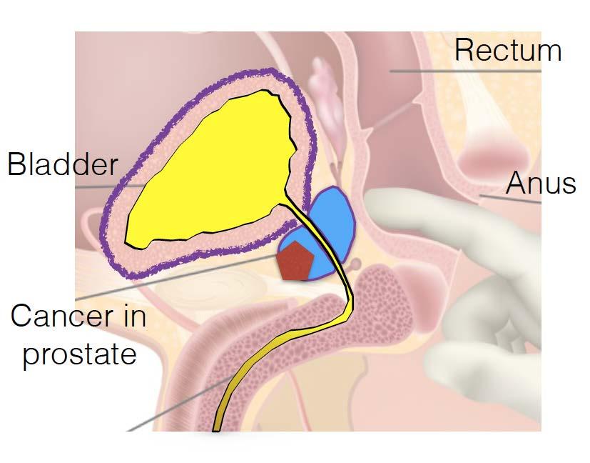 Enhanced mpmri can see prostate cancer