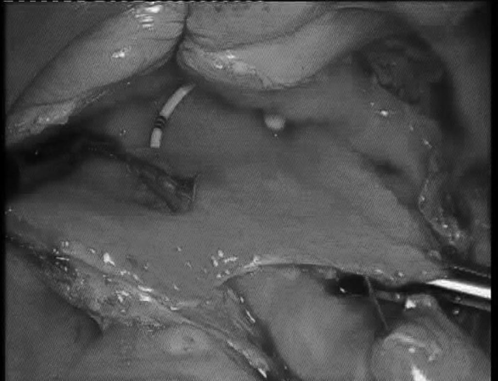 Diverticulum, ureter, and bladder depicted in the image. Figure 6. Ureteric reimplantation in progress.
