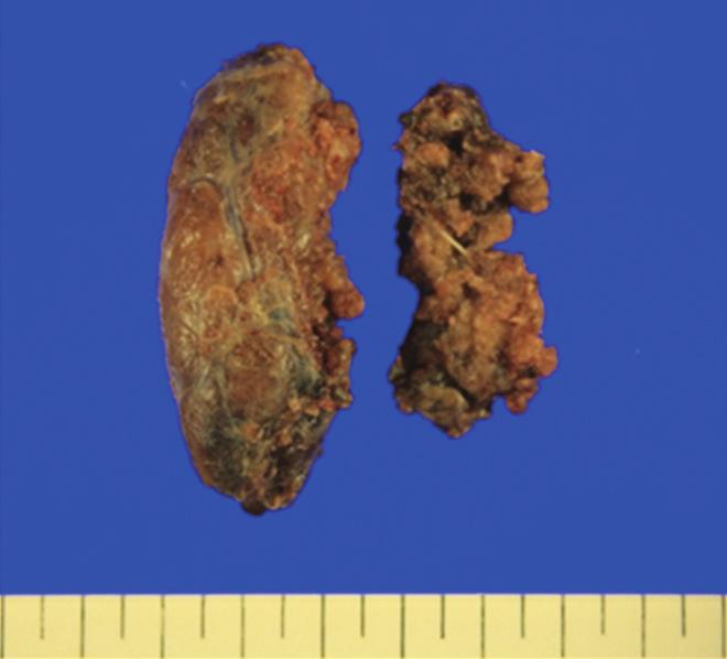 Refractory Thyrotoxicosis of Graves Disease Fig. 3. The postoperative pathology specimens showed right dominant diffuse goiter and no definite nodule was identified; Right thyroid gland was 7.8 4.4 2.