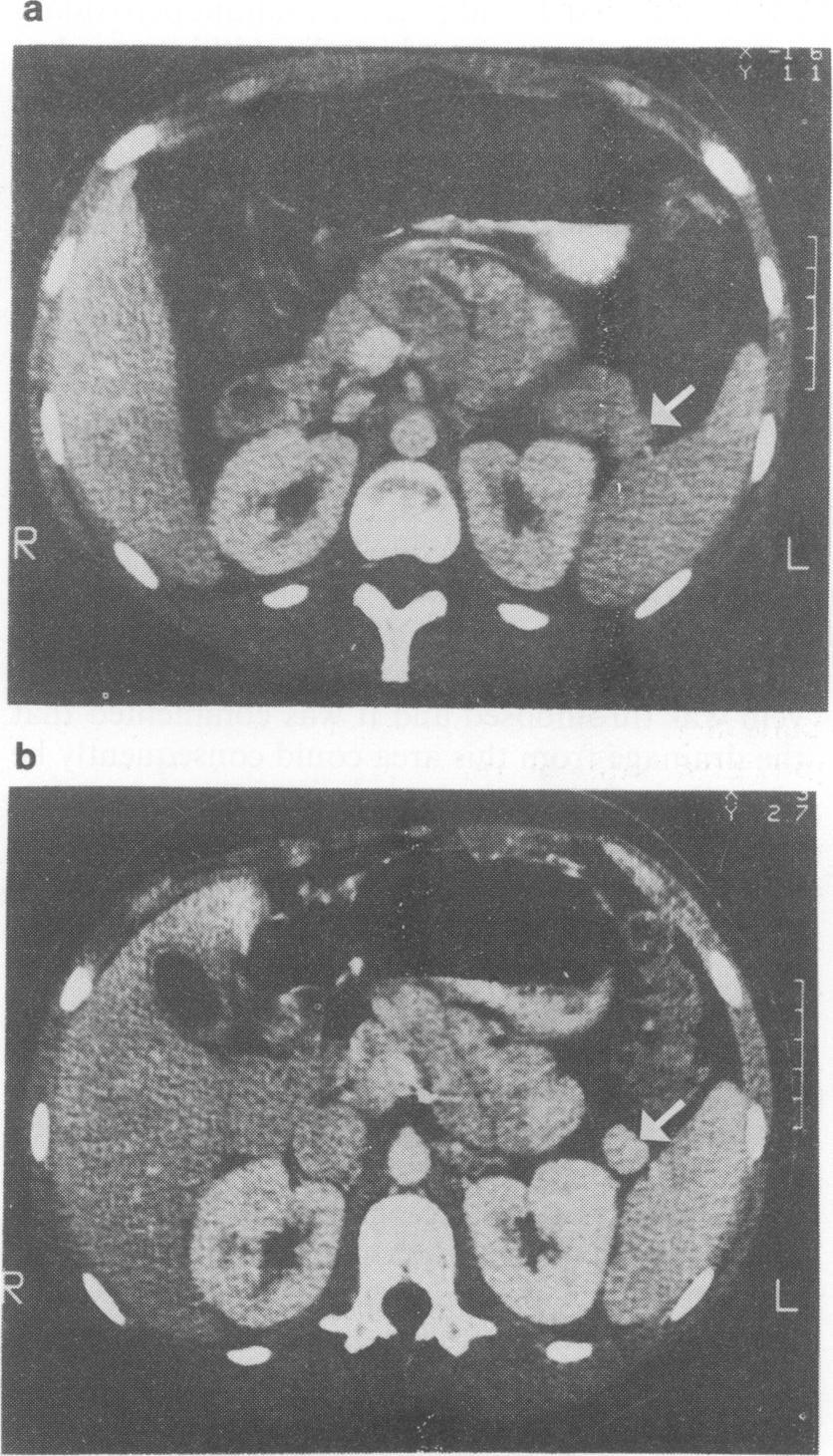 Hyperinsulinism and hypoglycaemia persisted post-operatively. A further abdominal CT scan was non-contributory and selective portal venous sampling showed an insulin peak in the portal vein.