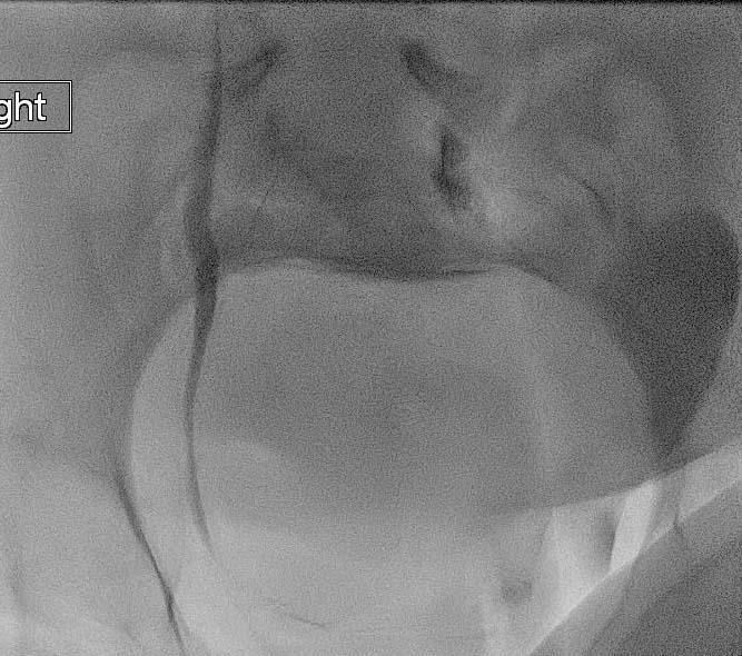 Case #1 Percutaneous nephrostomy tube placement by Interventional Radiology (IR) with