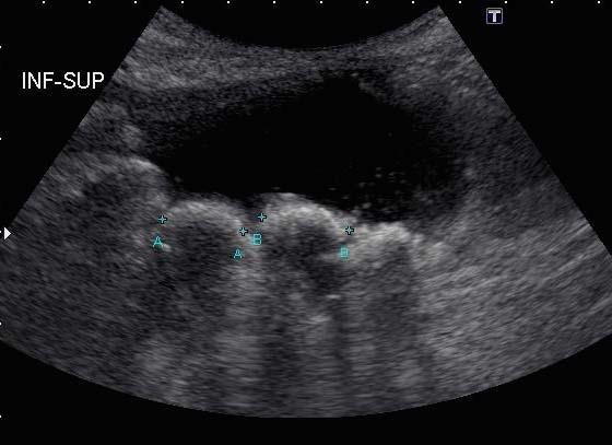Case #2 2011: Presented to GU team for management of urolithiasis - delightful young lady, successful college student (in Atlanta) - Mitrofanoff - torturous,
