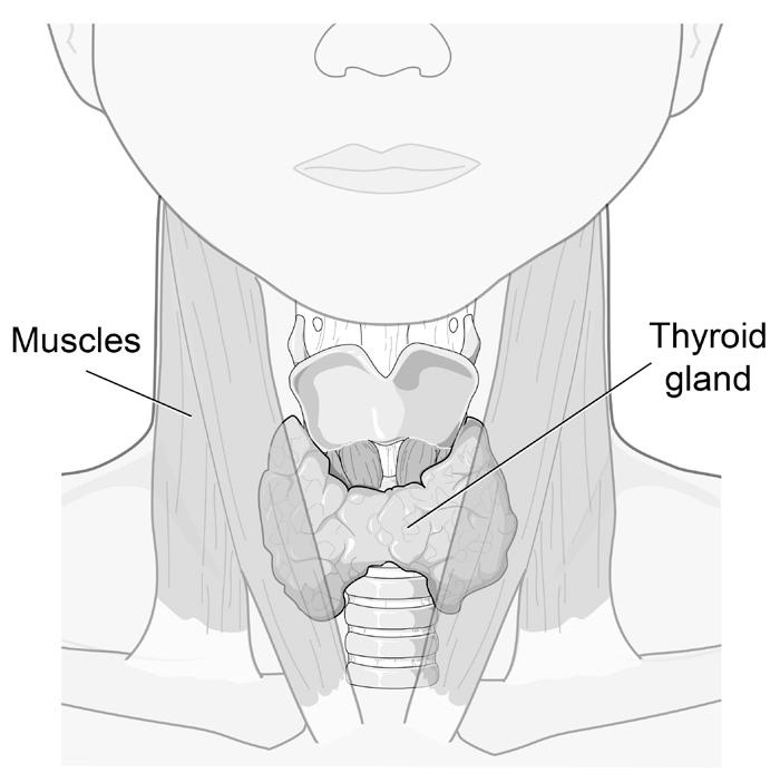 Graves Disease in Pediatrics Graves disease is a common cause of an overactive thyroid. It occurs in about 1 in 5000 children and teens. It occurs more often in females than males.