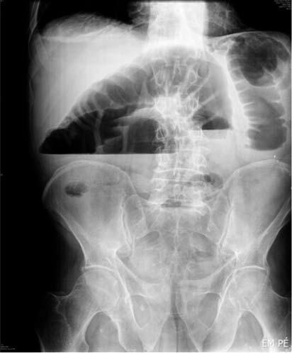 Pncretic Adenocrcinom Presenting s Acute Lrge Bowel Ostruction: Cse Report Lrge owel ostruction is common condition clssiclly cused y colonic mlignncy, volvulus, fecl impcttion, diverticulr disese,