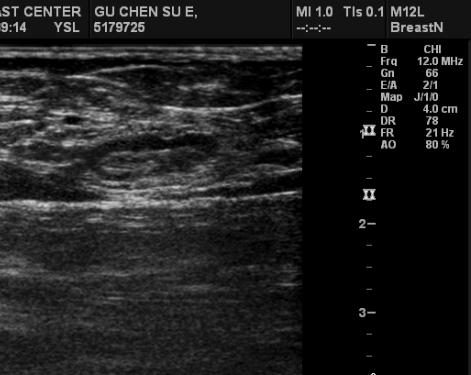 Ultrasound lymph node features of high risk for