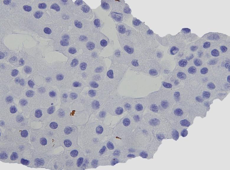 Figure 10. Negative immunostaining with alpha-fetoprotein (AFP)(Original magnification 400x) AFP serum level was not provided in our case.