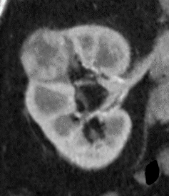 Location Relative to the Polar Lines Polar lines and axial renal midline are best imaged on oblique reformats; in the plane of the renal sinus Fig. 1 Figure 1: A 3.