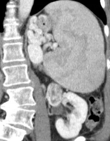 location relative to the ribs Sagittal Coronal High kidney is a challenge for