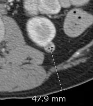 Adjacent bowel, organs, vessels and nerves Tumor location Tumor surroundings: Ablation zone must extend