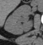 Angiomyolipoma Horseshoe kidney