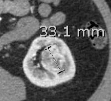 5 cm (B) (D) Same tumor measured 3.