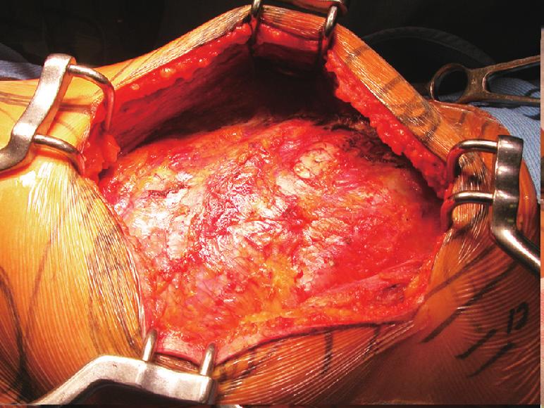 Preservation of the LD muscle is also important because its flaps can be used in a variety of surgical treatments for vital conditions (8,11).